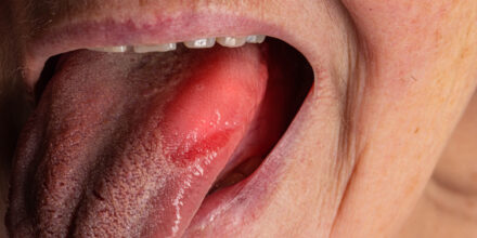 Tong met Oraal Allergie Syndroom (OAS)